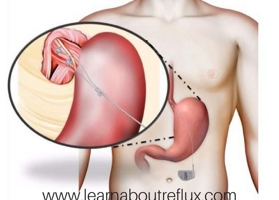 EndoStim