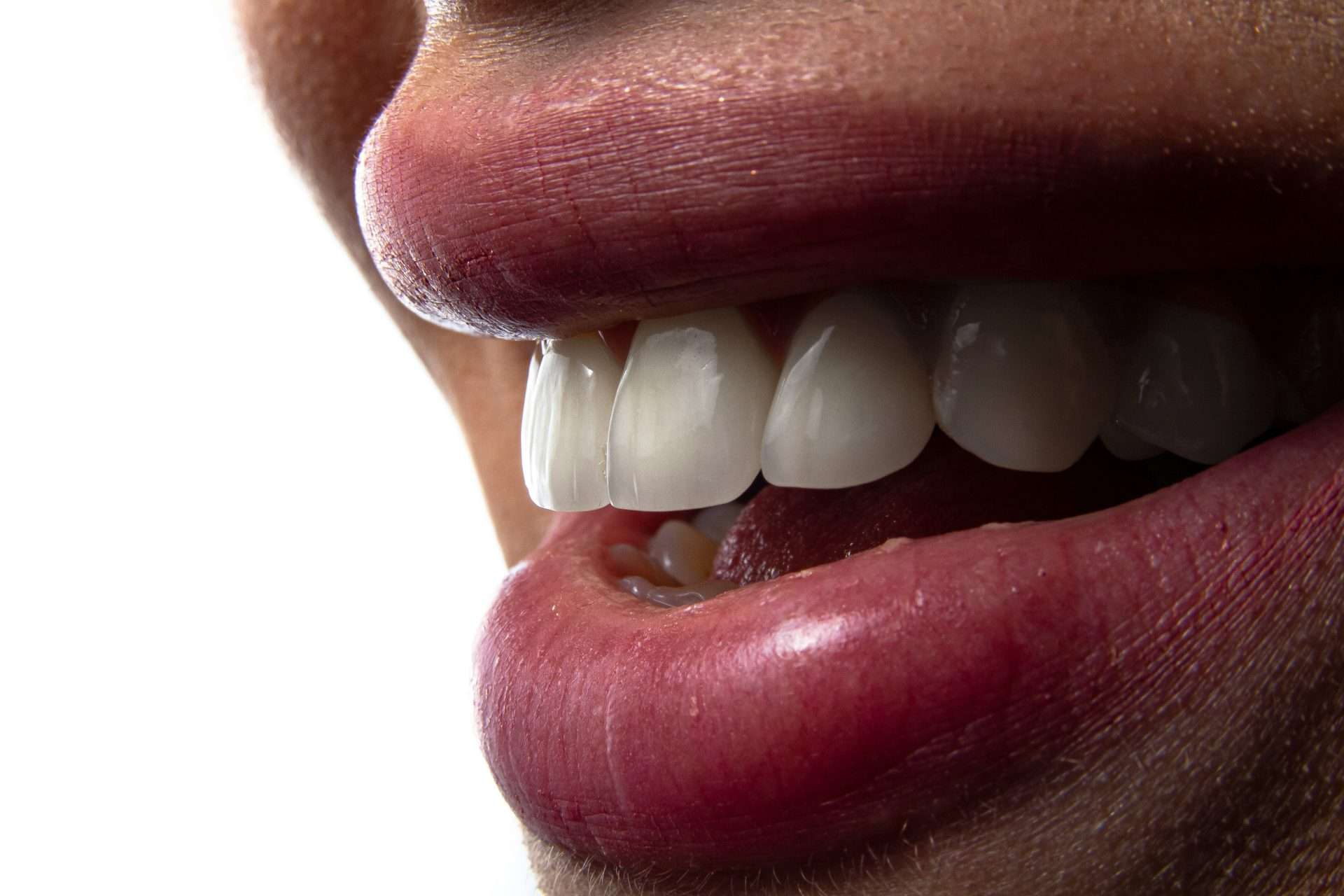 Close-up of teeth showing enamel surfaces where early acid erosion from reflux can occur